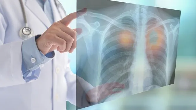 Investigadors assoleixen l’avanç més gran en tres dècades per frenar el càncer de pulmó