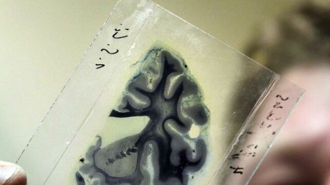 Descobreixen dos nous gens implicats en la malaltia d’Alzheimer