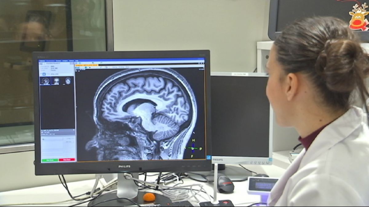 Descobreixen alteracions cerebrals innates que influeixen en l’alzheimer